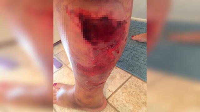 Mujer acaba con un agujero en la pierna tras someterse a una liposucción [FOTOS]