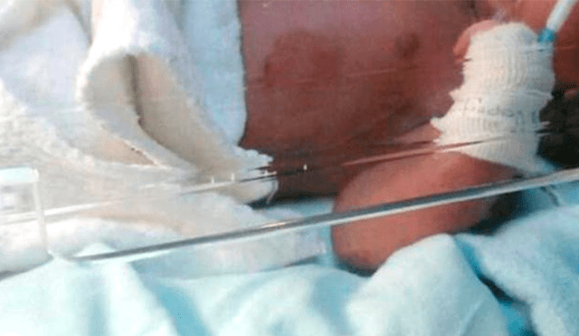Bebé de 8 meses víctima de maltrato infantil termina con el brazo fracturado