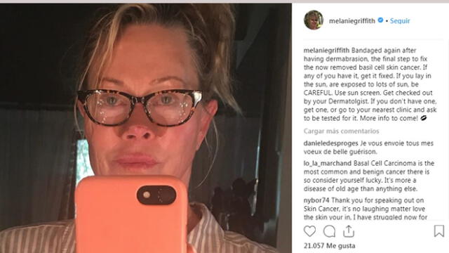 Melanie Griffith publica foto que evidencia el cáncer de piel que padece