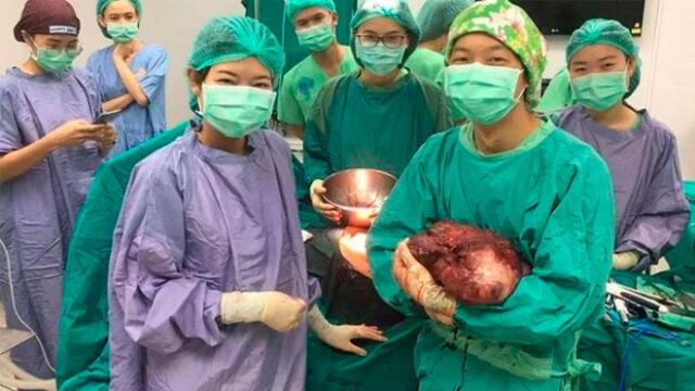 Enfermeras y asistentes con el tumor de 5 kilos en mano. Foto: Viral Press.