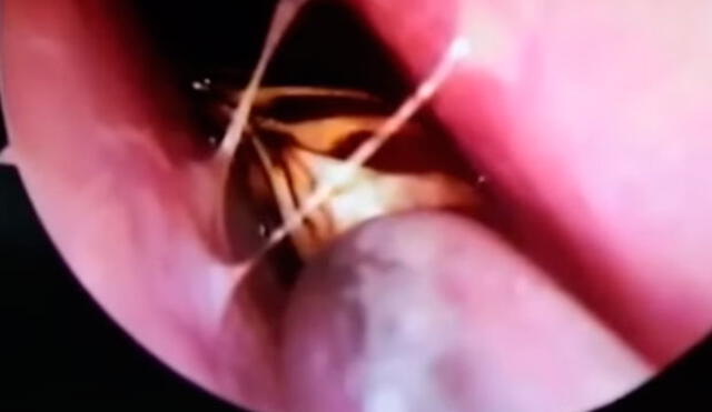 En YouTube, médicos encontraron una cucaracha viviendo dentro de la cabeza de una mujer | VIDEO