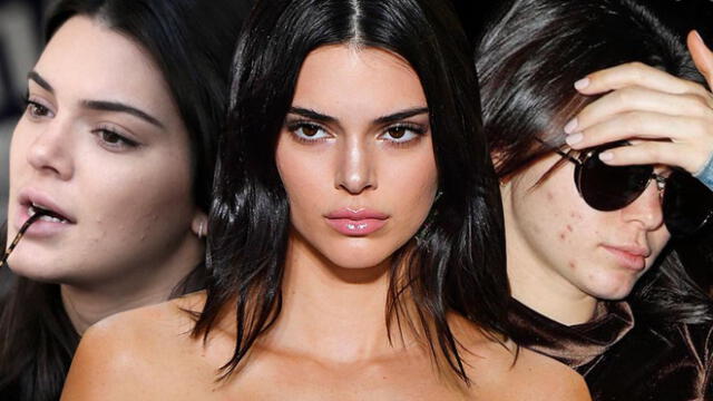 Kendall Jenner sufre por no poder ocultar las cicatrices del acné en su cara