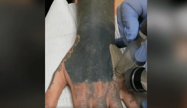 Facebook viral: joven decide quitarse tatuaje del brazo, sin imaginar el terrible resultado que tendría