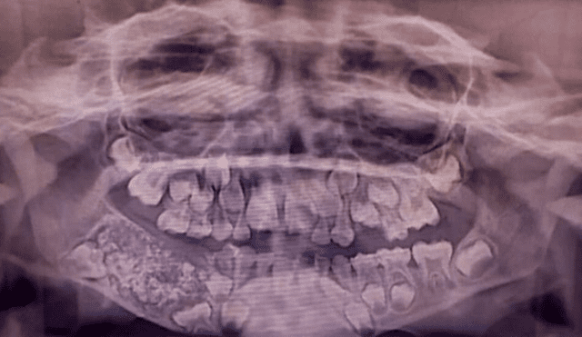 Niño de 7 años fue víctima de afección por la que tenía unos 500 dientes dentro de tumor. Foto: Instituto de Ciencias Médicas y Técnicas Saveetha