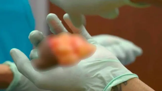 Médico le extirpa un “tercer testículo” a joven luego de un extraño crecimiento [VIDEO]
