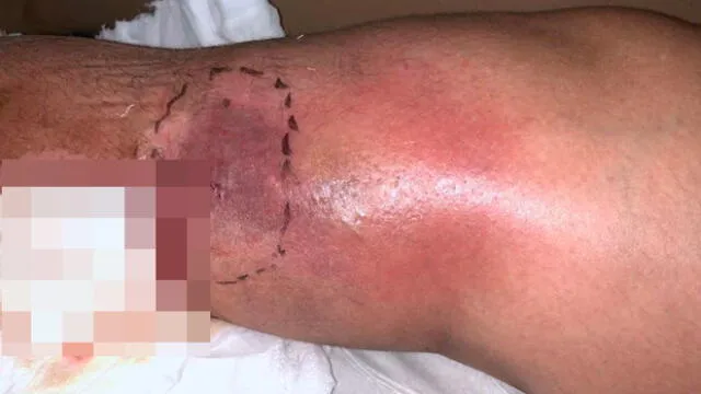 Mujer acaba con un agujero en la pierna tras someterse a una liposucción [FOTOS]