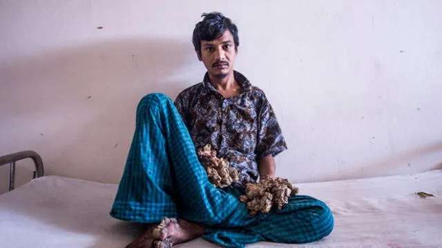 Abul Bajandar fue conocido en 2016 como el 'hombre árbol' y hoy hace triste pedido. Foto: AFP