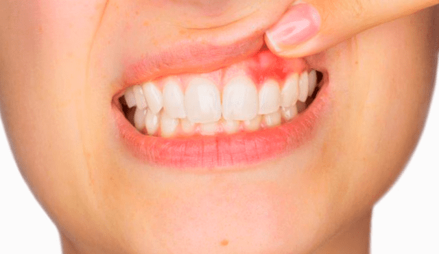 ¿Cómo se genera la gingivitis y cuál es el tratamiento?