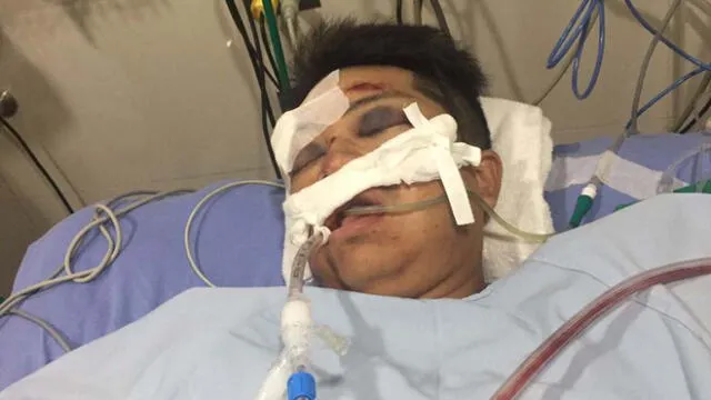 Hombre NN atropellado está grave en clínica de Surco