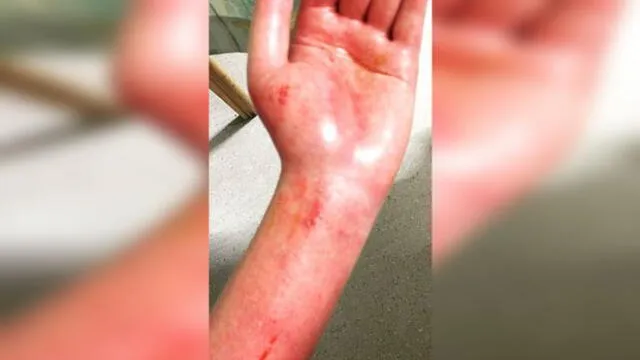 Mujer pierde el brazo luego de electrocutarse al tratar de enchufar su laptop [FOTOS]