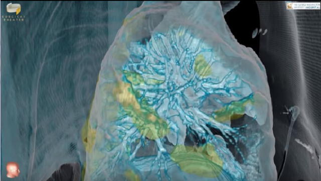 Coronavirus y pulmones