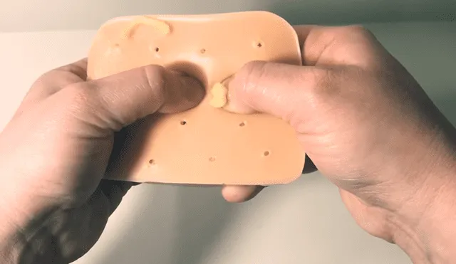 YouTube Viral: Lanzan juguete antiestrés para reventar granos llenos de pus [VIDEO]
