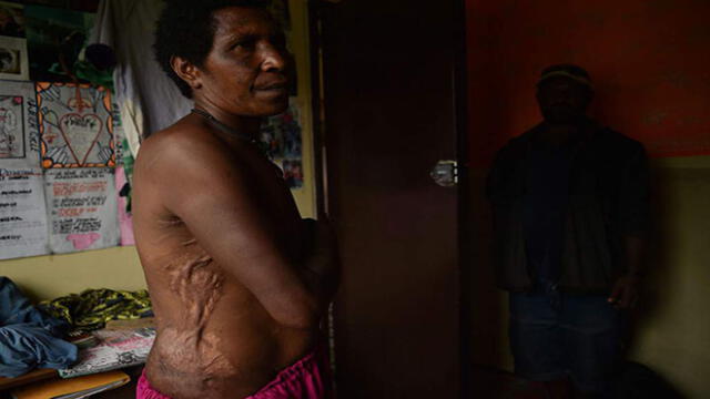 Cacería de brujas aterroriza a mujeres de Papúa Nueva Guinea: son violadas y quemadas vivas