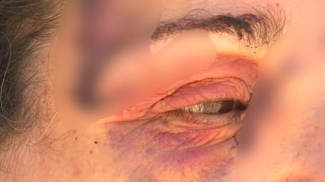 Mujer estuvo a punto de perder la vista tras ser atacada brutalmente por un canguro [VIDEO]