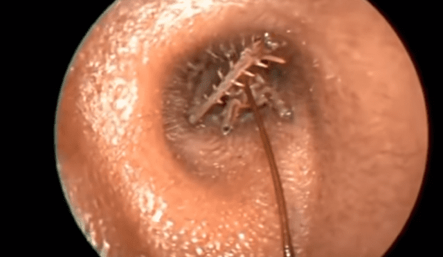 YouTube viral: médico encuentra 'misteriosa criatura' dentro de oído que genera terror [VIDEO]