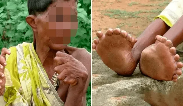 Mujer que nació con 20 dedos en los pies y 12 en las manos pide que no le digan ‘bruja’ [FOTOS] 