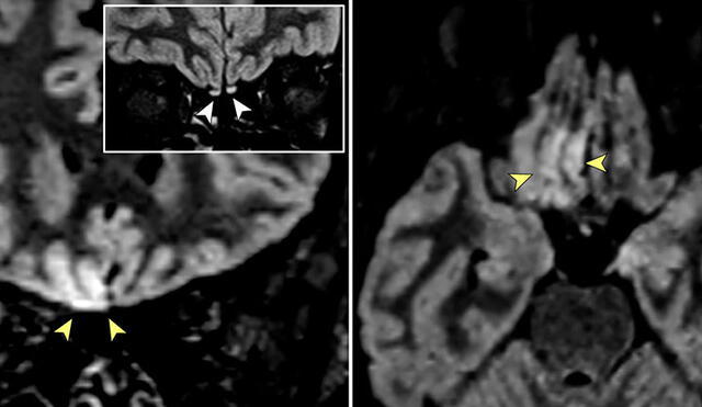 Imágenes que muestran hiperintensidad cortical en el giro recto derecho del cerebro. Foto: JAMA Neurology