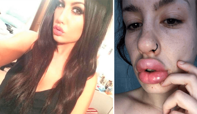 Mujer adicta a cirugías se rellena sus labios exageradamente y termina infectado de pus [FOTOS]