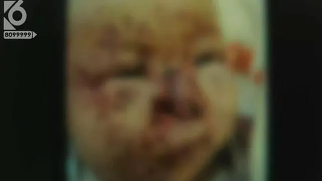 Bebé es mordida por ratones y queda con más de cien heridas en la cara