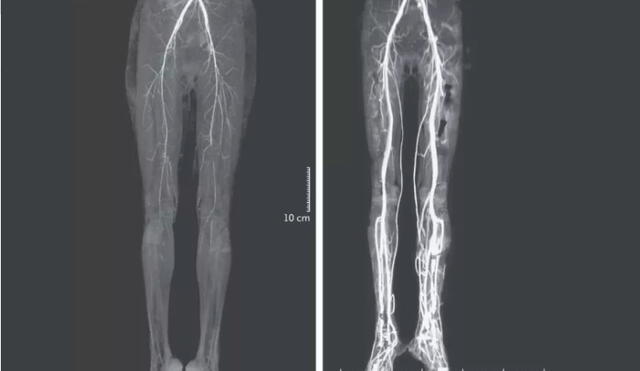La imagen muestra una tomografía computarizada de las piernas de la mujer antes y después del tratamiento de la enfermedad. Foto: The New England Journal of Medicine.