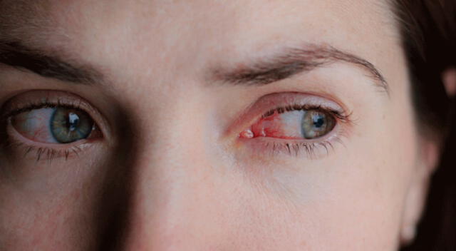 La conjuntivitis puede ocasionar disminución de la vista, advirtió el Minsa