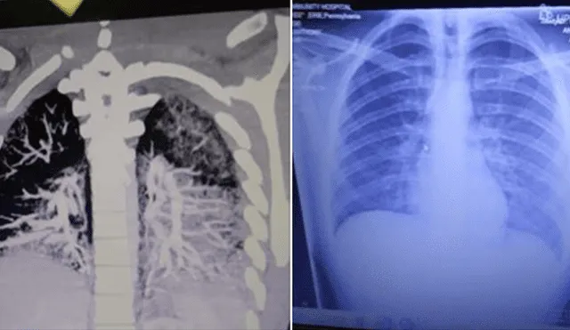 Así se ven los pulmones de Anthony Mayo. Foto: Facebook.
