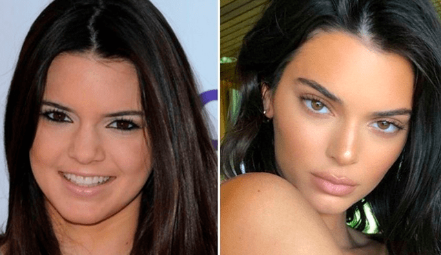 Kendall Jenner, antes y después de cirugías.