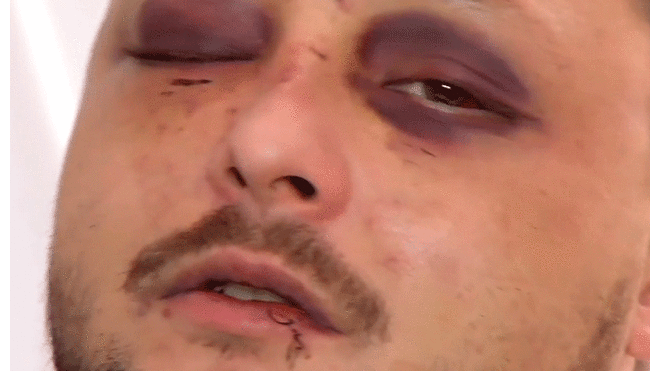 Queda con el rostro desfigurado tras defender a mujer maltratada por su pareja [VIDEO]