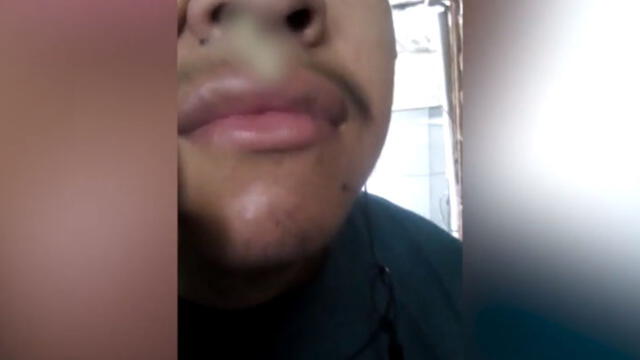Negligencia en hospital de Collique: médicos dejaron gasa en nariz de universitario [VIDEO]