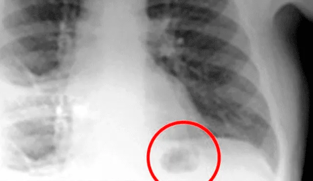 Creyó que una mancha en sus pulmones era cáncer, pero se llevó tremenda sorpresa al descubrir la verdad [FOTO]