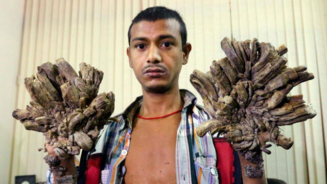 Abul Bajandar fue conocido en 2016 como el 'hombre árbol' y hoy hace triste pedido. Foto: AFP