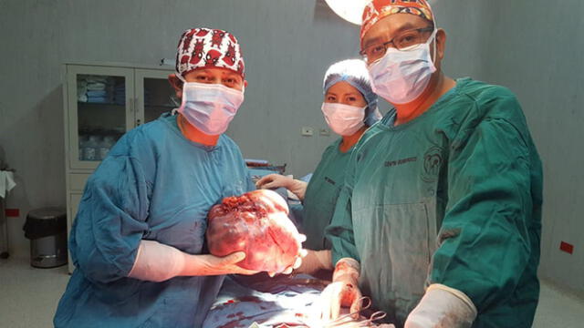 Médicos extrajeron tumor de 4 kilos de ovario de una mujer en Arequipa