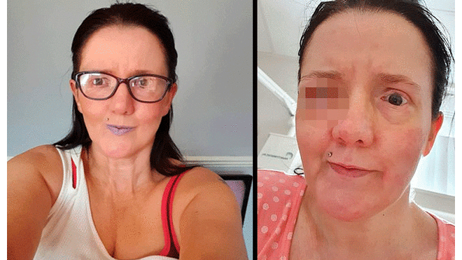 Mujer se desgarra la córnea al secarse la cara y médicos le extirpan su ojo para salvarla [FOTOS]