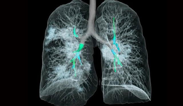 Placa computarizada de los pulmones de un paciente afectado por la COVID-19. Imagen: Radiology.