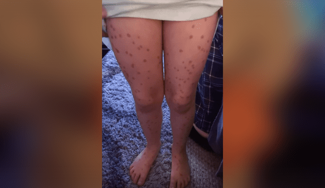 Facebook viral: niña usa increíble “truco” para enfermarse de varicela, pero todo le sale mal [FOTOS] 