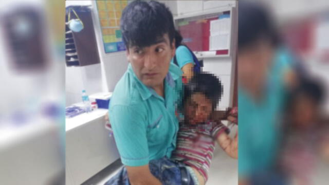 Amazonas: Niño perdió tres dedos tras manipular explosivo 