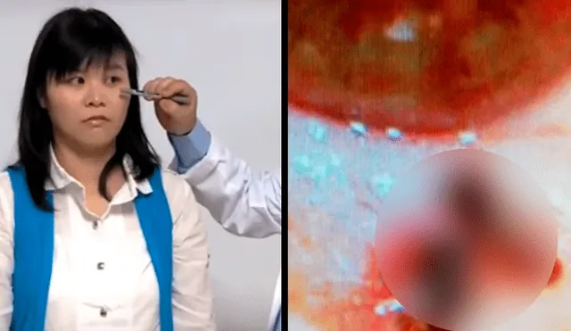 YouTube viral: acude al doctor porque le dolía el ojo y le extraen varias criaturas que vivían dentro [VIDEO]