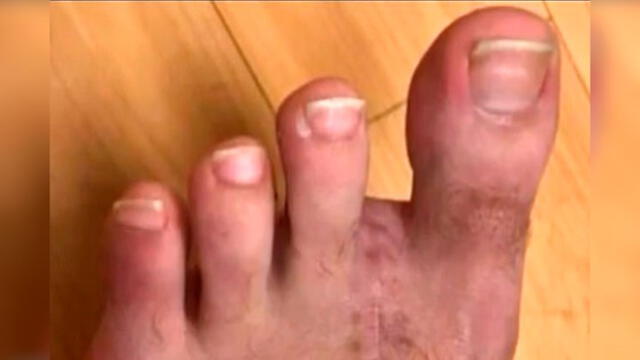 Cirujanos extirpan dedo del pie a paciente para reemplazar el pulgar de su mano [FOTOS]