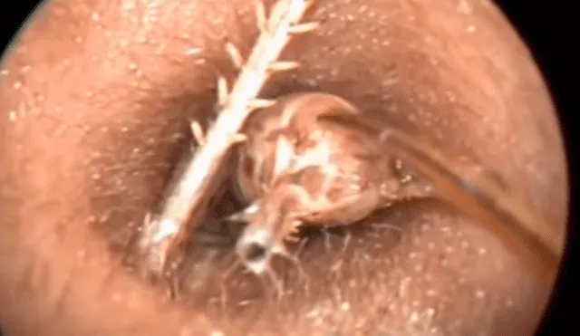 YouTube viral: médico encuentra 'misteriosa criatura' dentro de oído que genera terror [VIDEO]
