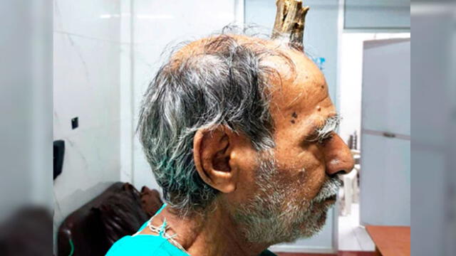 Shyam Lal Yadav sufrió un golpe y le comenzó a crecer un cuerno en la cabeza. Foto: difusión
