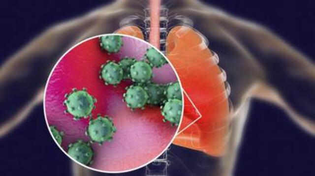 Cuando el coronavirus infecta los alvéolos de los pulmones es donde se intensifica las consecuencias mortales. Foto: BBC.