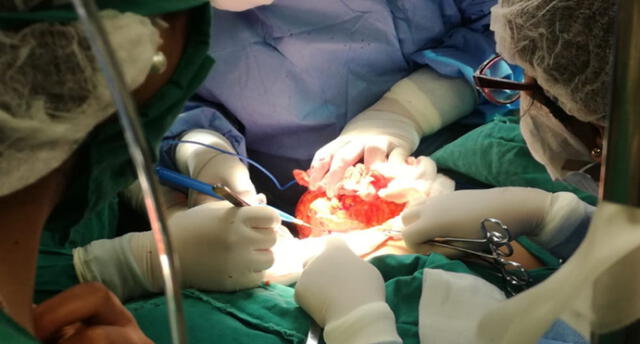 Médicos cusqueños lograron extirpar tumor gigante de mama