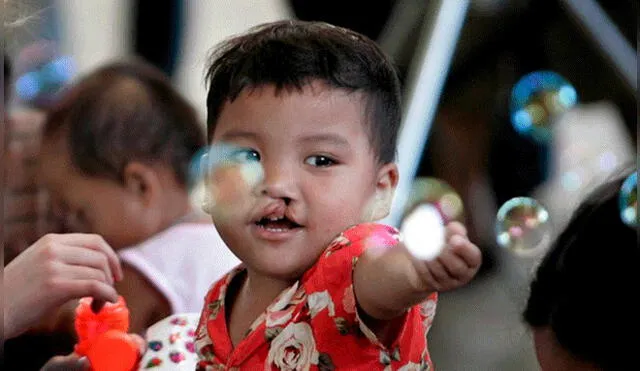 En Cusco, operarán gratis a niños con labio leporino o paladar hendido 