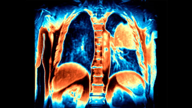 La inmunoterapia ha sido incluida en el tratamiento de cáncer de pulmón. Imagen referencial: resonancia magnética de los pulmones muestra los tumores (naranja) en el lado derecho. Science Source.