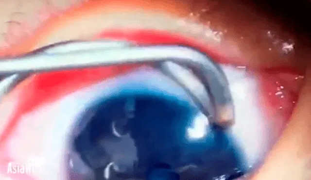 Facebook viral: médico graba el preciso instante en que retira gusanos del ojo de un bebé y sorprende a miles