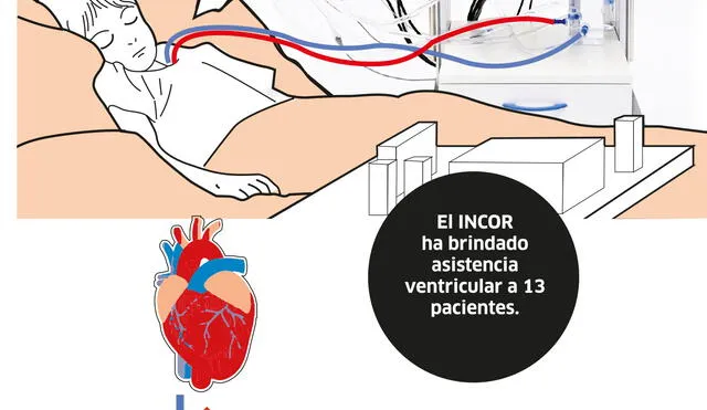 Dispositivo de asistencia ventricular [VIDEO]