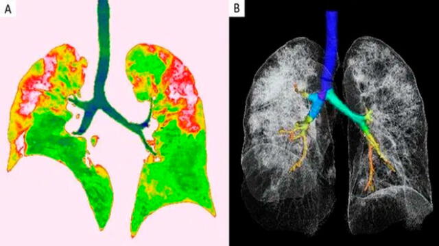 Tomografías muestran el daño que causa el coronavirus en los pulmones [FOTOS]