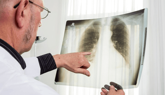 Fumó por 30 años y quiso donar sus pulmones: los rechazaron porque estaban podridos [VIDEO]