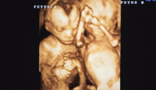 Instagram: Ecografía 4D revela imagen de bebés gemelas dándose un tierno "beso"