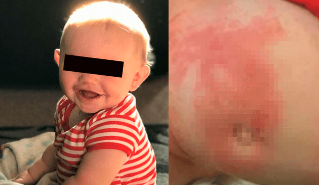 Bebé queda con heridas abiertas en la piel tras ‘quemaduras’ de su pañal